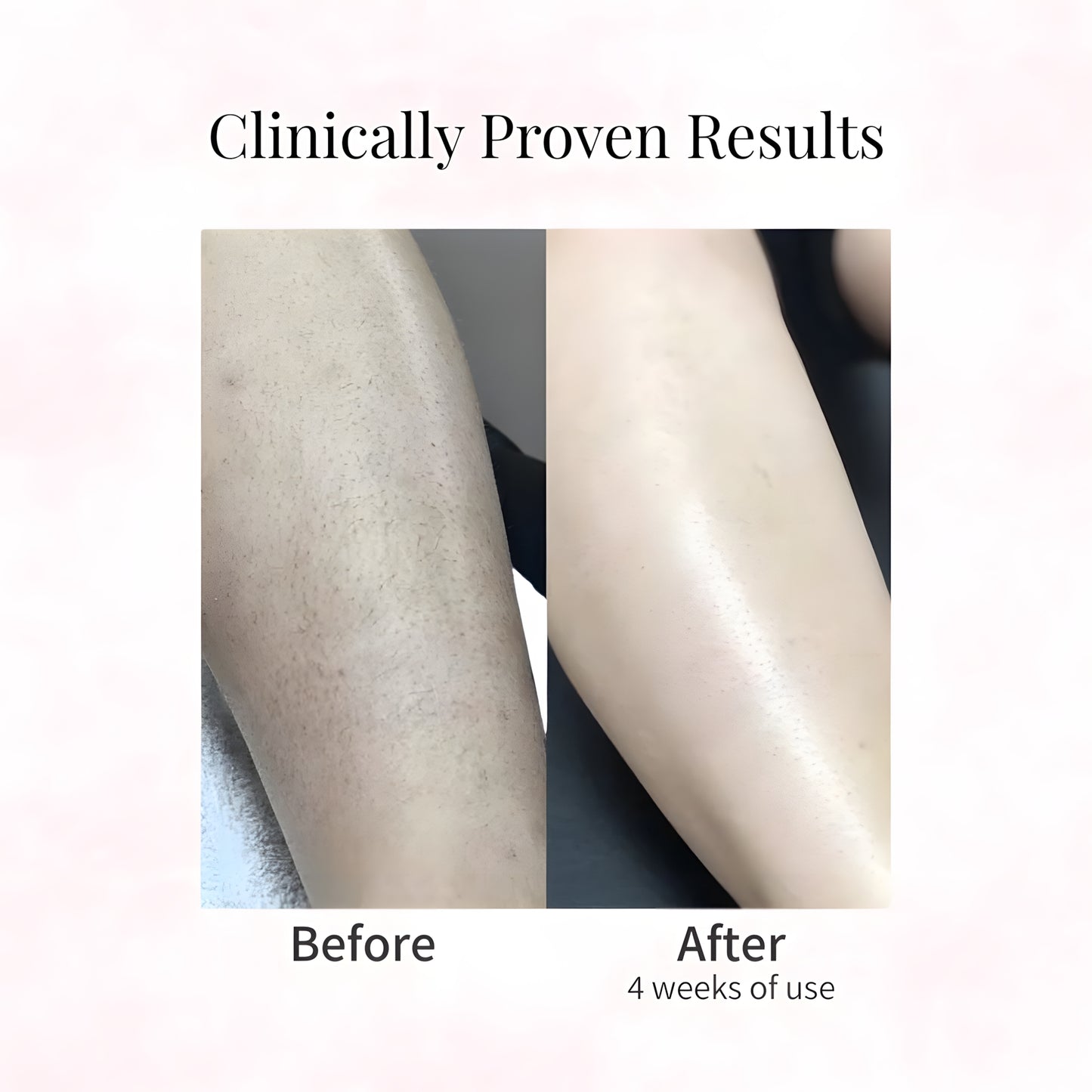 Cyperus Rotundus Oil for Hair Removal