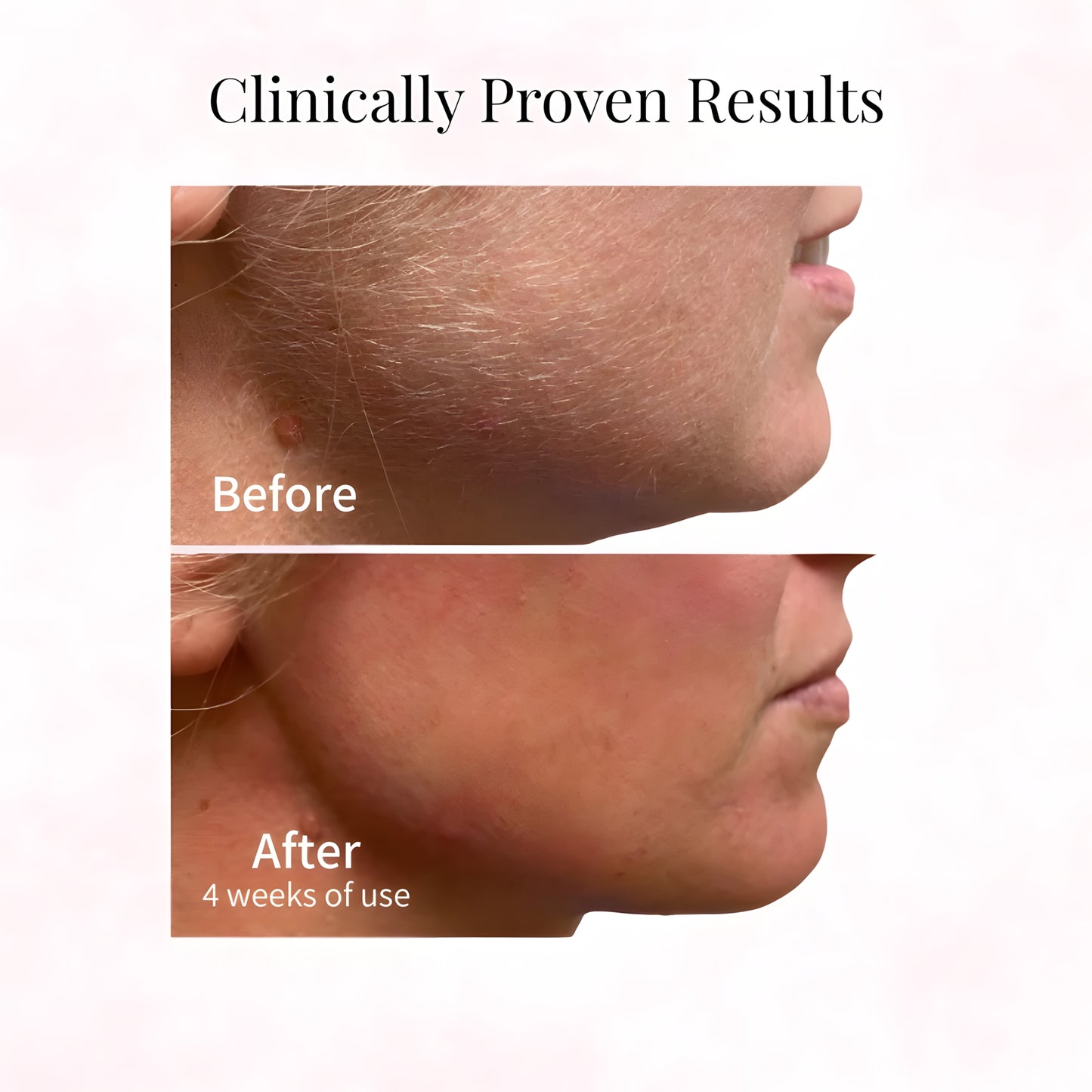 Cyperus Rotundus Oil for Hair Removal